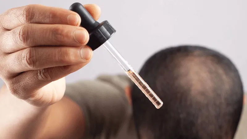 ¿Es Necesario Tomar Minoxidil Después de un Trasplante Capilar?